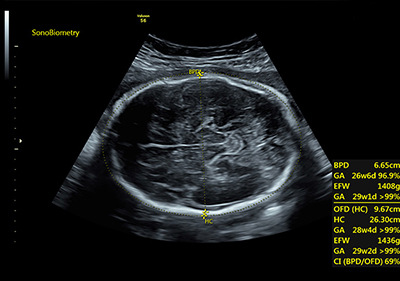 SonoBiometry đo đầu thai nhi