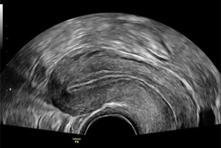 Góc tối đa cho thấy tử cung bình thường từ hố tử cung đến cổ tử cung.