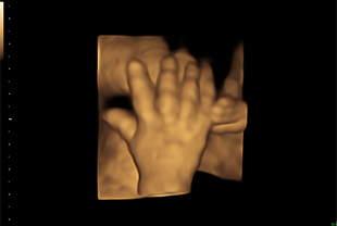 Bề mặt 3D tay của thai nhi.