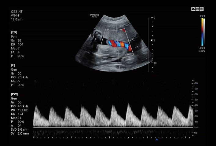 HS40 Umbilical cord using PW