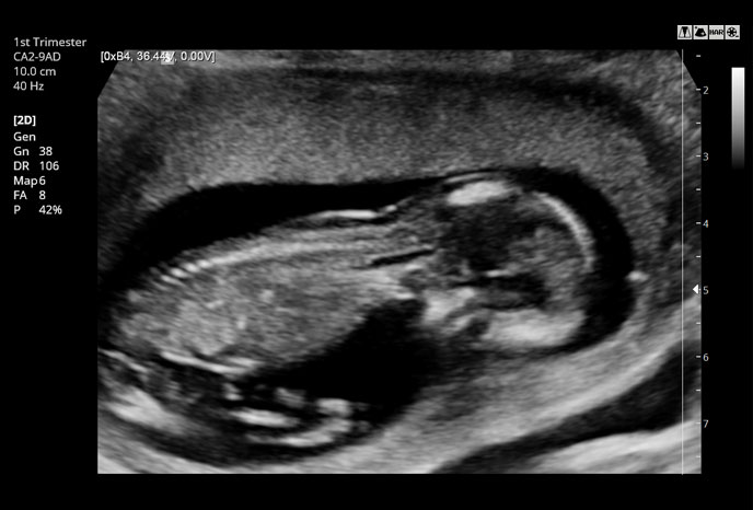 1st trimester