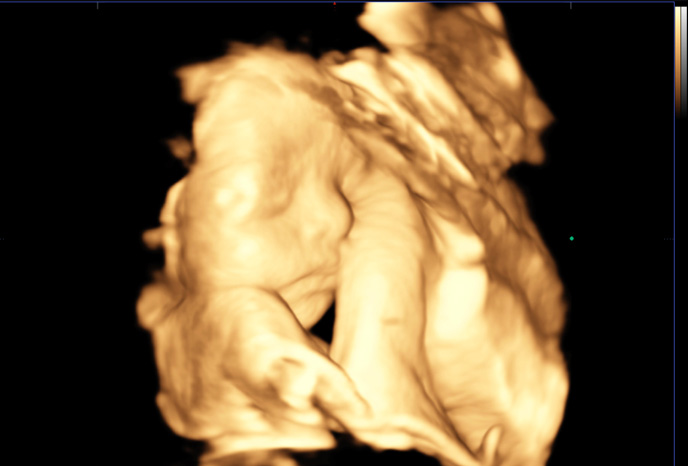Fetal face in 3D
