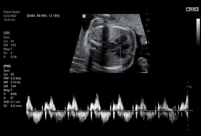 Fetal heart with PW