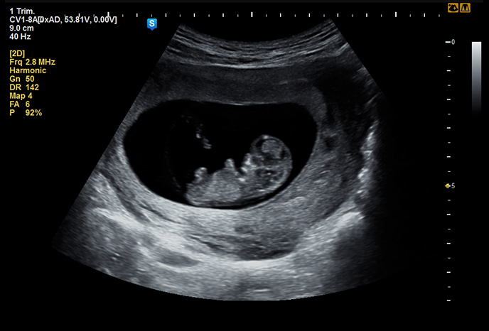 HS60 - 10 week fetus