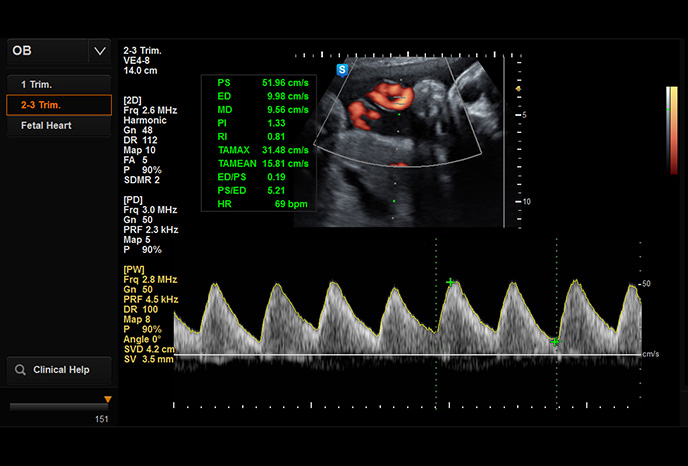 HS60 - Umbilical cord in PW