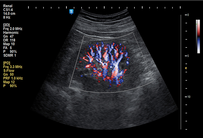 Kidney with S-flow